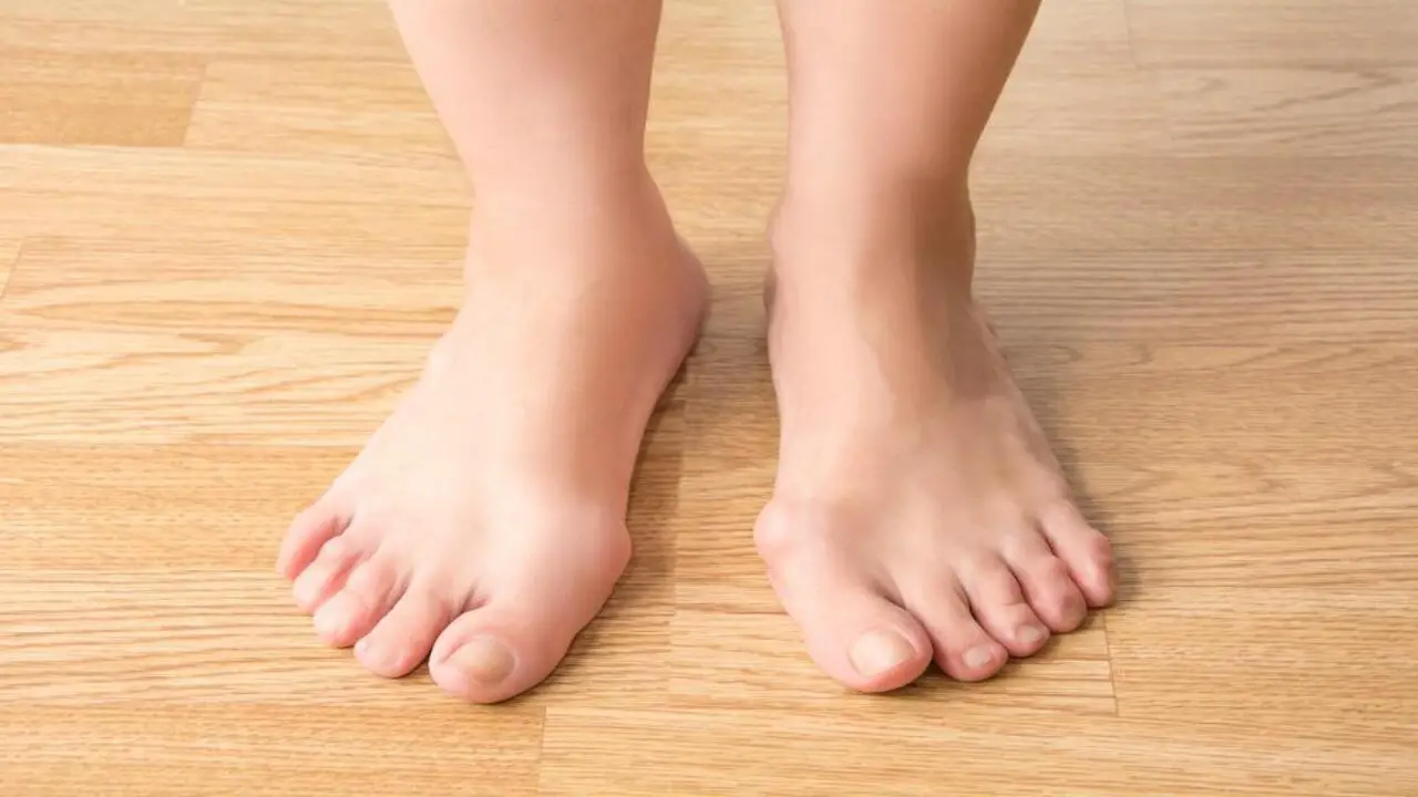 Common Causes Of Bunions