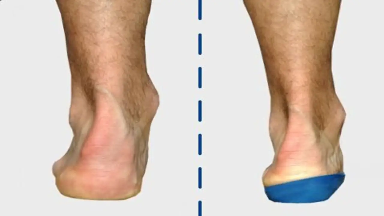 Correcting Foot Alignment And Overpronation